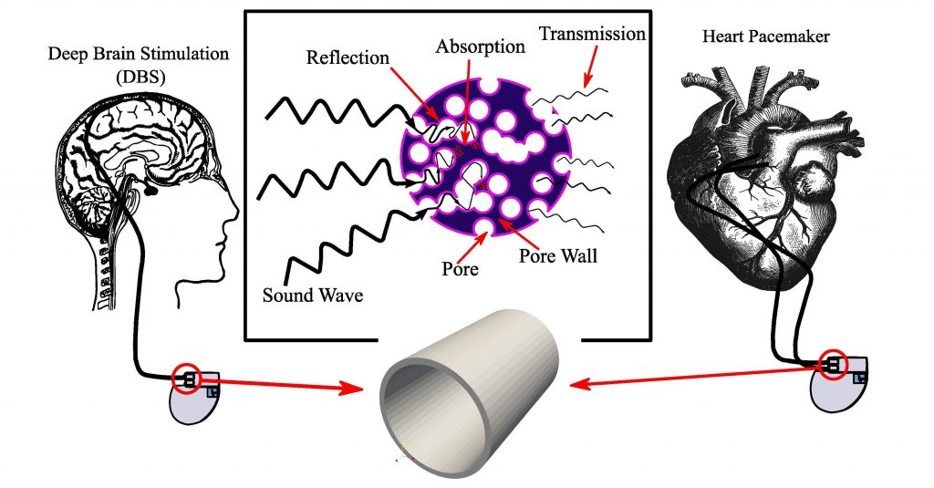 The authors combined graphene, polypropylene, and nanoclay to create novel biomaterials to use in the outlet gate of brain and heart pacemakers, the component responsible for controlling and transmitting signals. Testing five different ratios of the materials, they discovered the pores within the biomaterial play a vital role in mitigating noise interference. Credit: Baraa Chasib Mezher